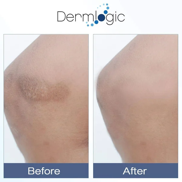 Vitamin K Cream- Moisturizing Bruise Healing Formula. Dark Spot Corrector for